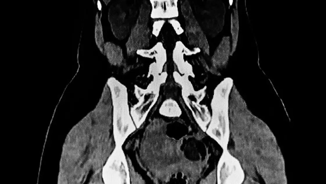 7-Kilo Tumor Removed from Woman in Rare Surgery at Huzurnagar Hospital