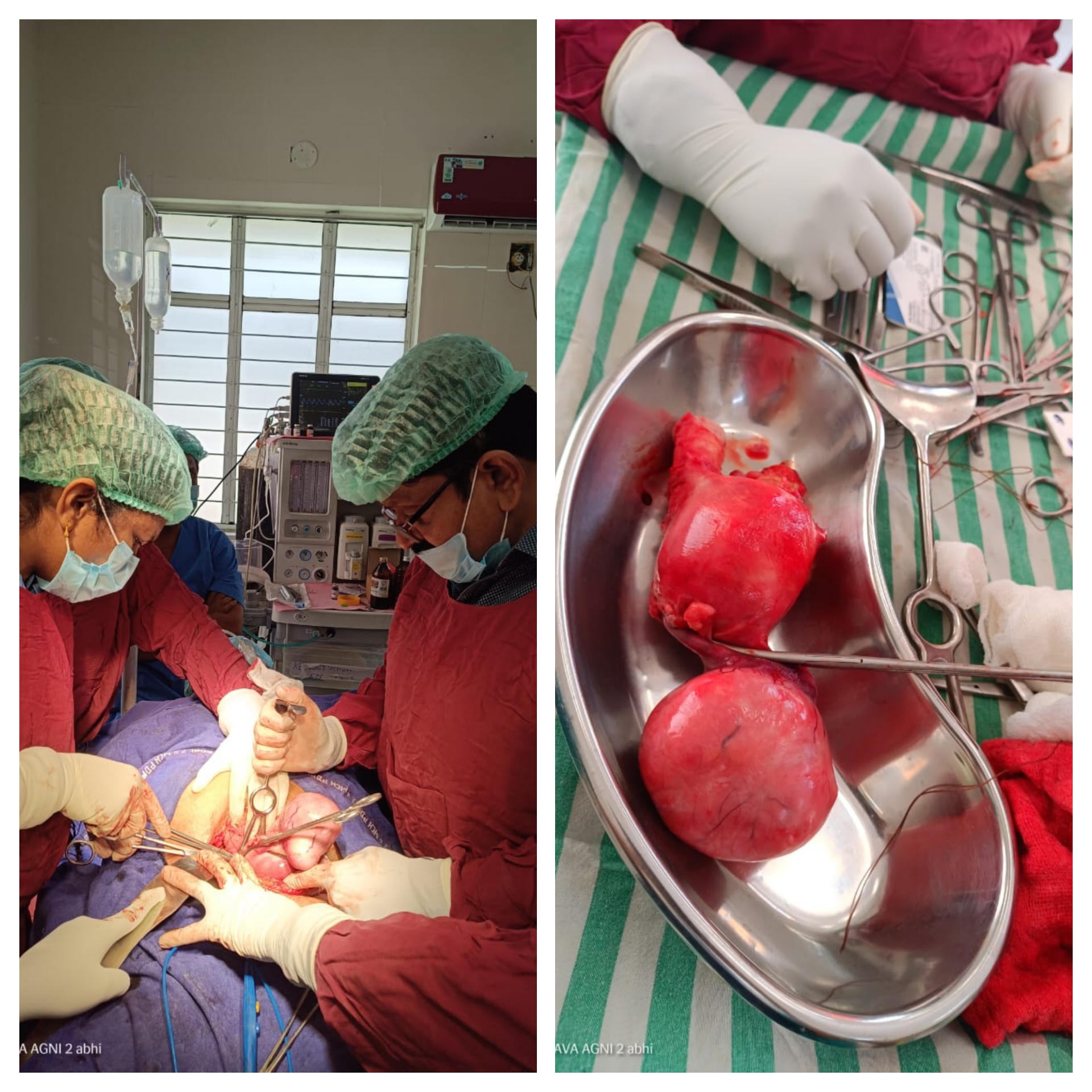 Doctors Perform Complex Surgery at Peddapalli District Hospital